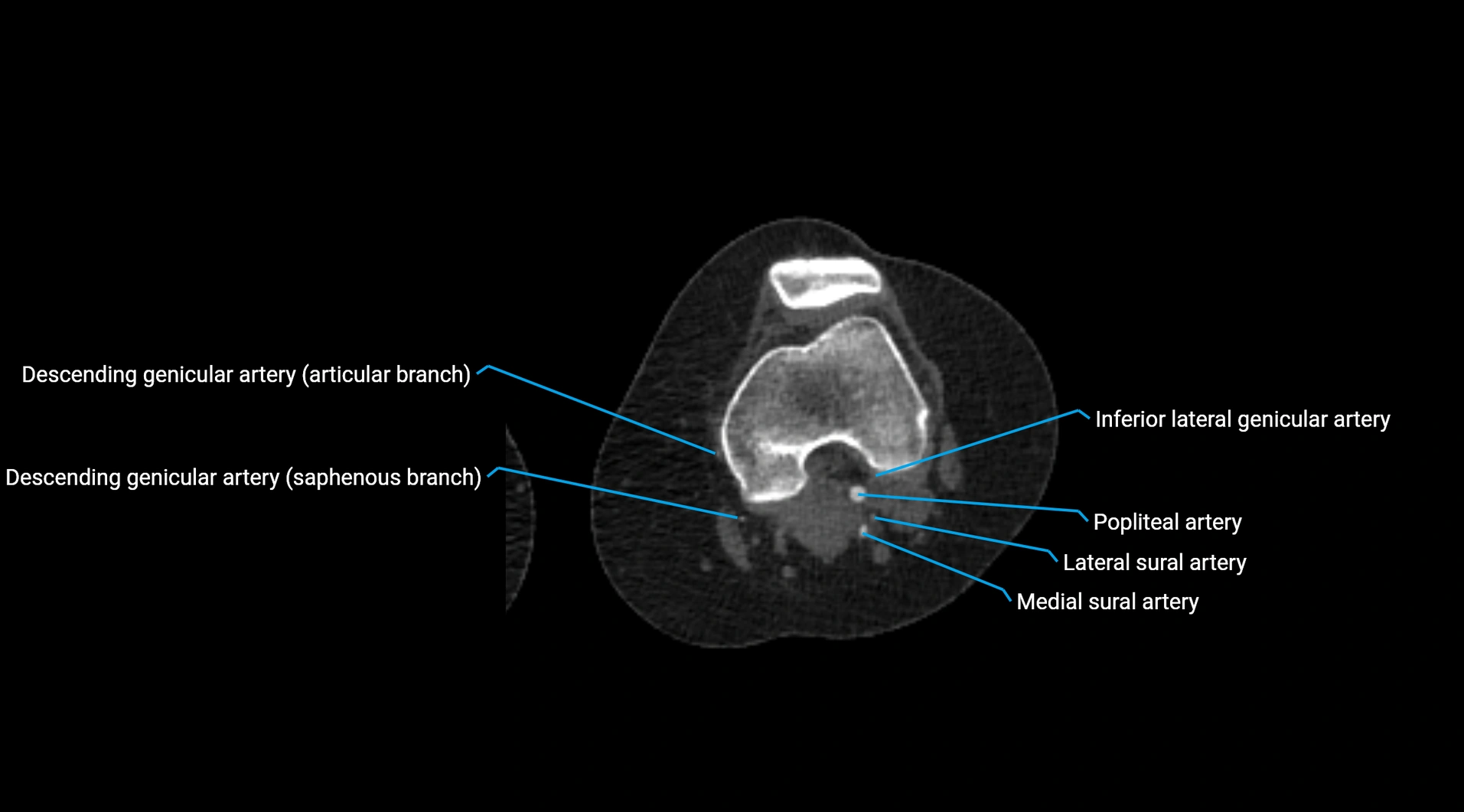 CTA lower limb cross sectional anatomy labelled image _170.webp